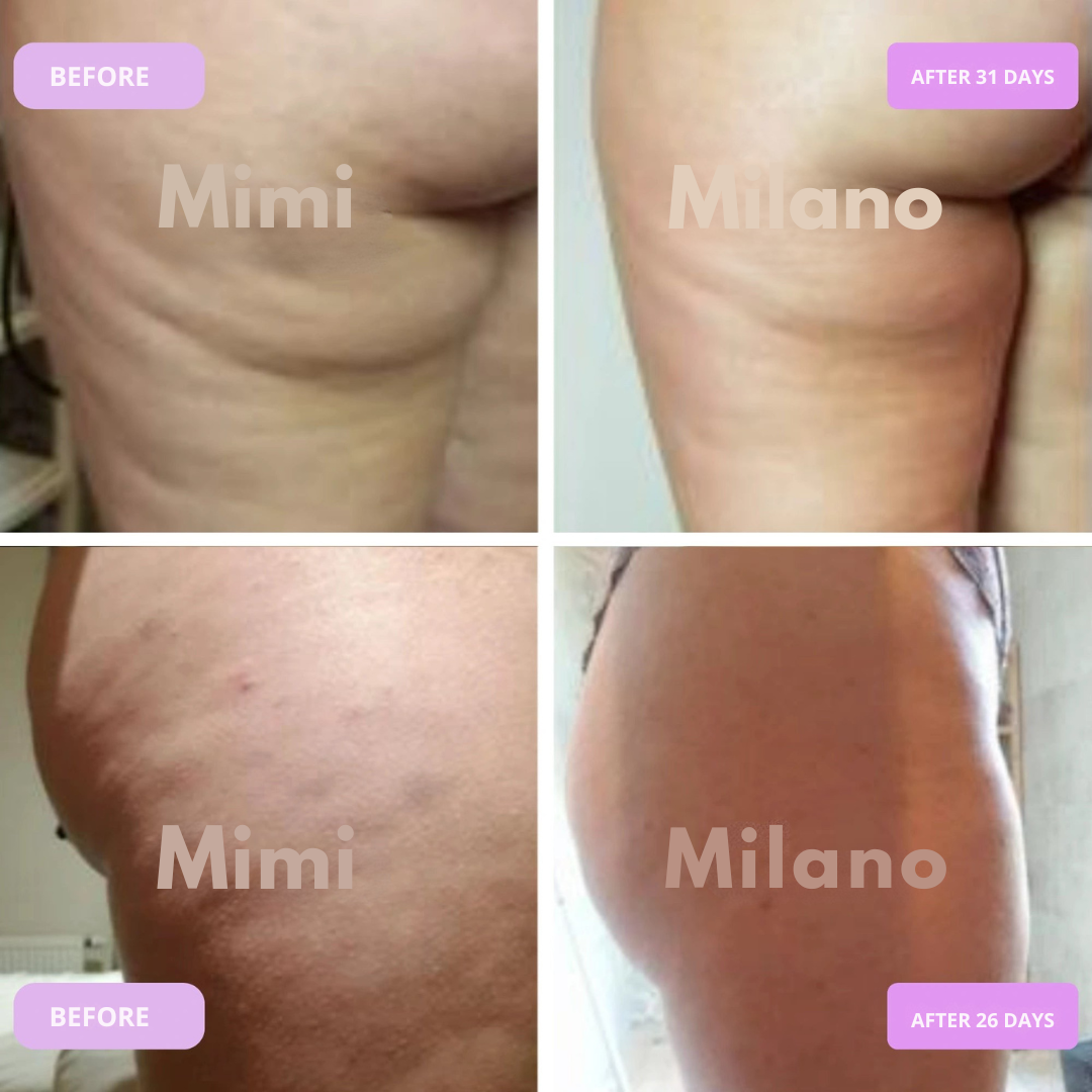 Mimi Cupper- reduce cellulite and stretch marks